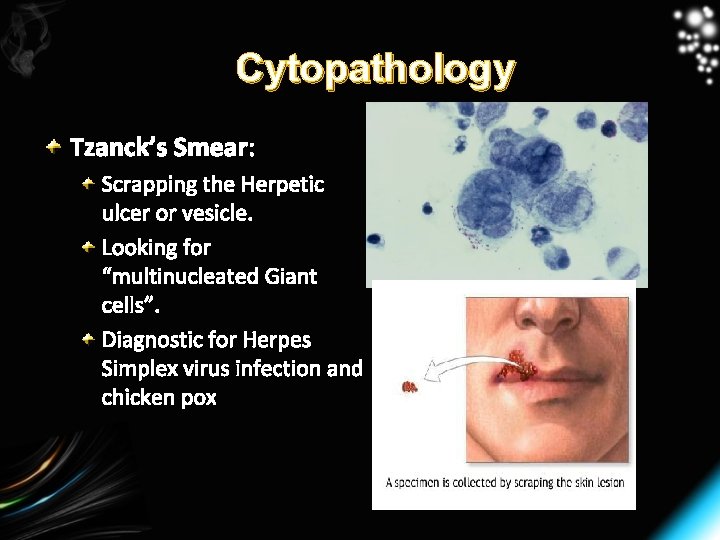Cytopathology Tzanck’s Smear: Scrapping the Herpetic ulcer or vesicle. Looking for “multinucleated Giant cells”.