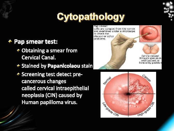 Cytopathology Pap smear test: Obtaining a smear from Cervical Canal. Stained by Papanicolaou stain.