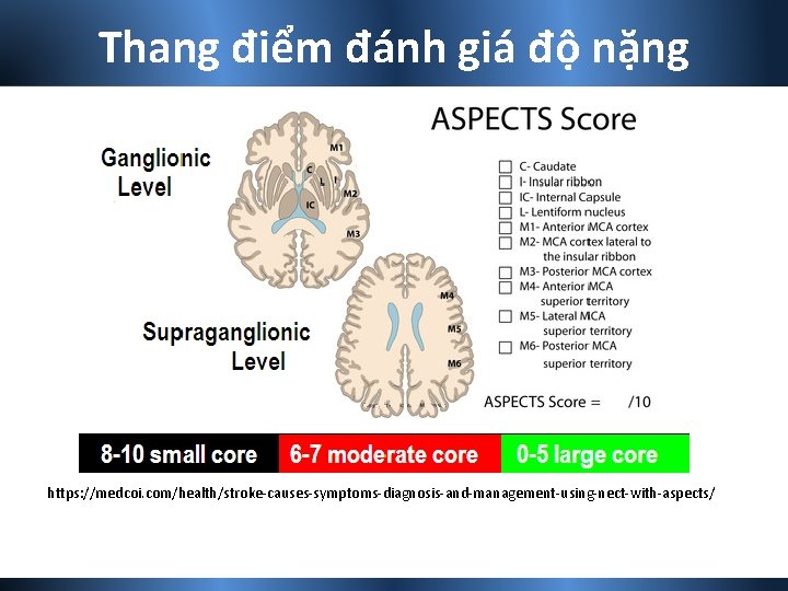 Thang điểm đánh giá độ nặng https: //medcoi. com/health/stroke-causes-symptoms-diagnosis-and-management-using-nect-with-aspects/ 