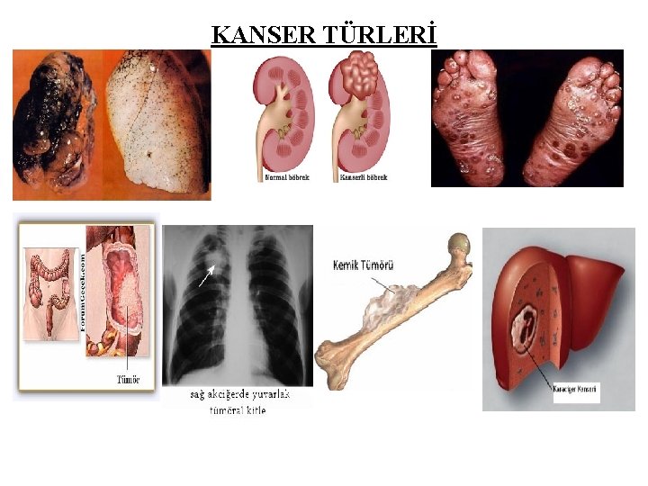 KANSER TÜRLERİ 