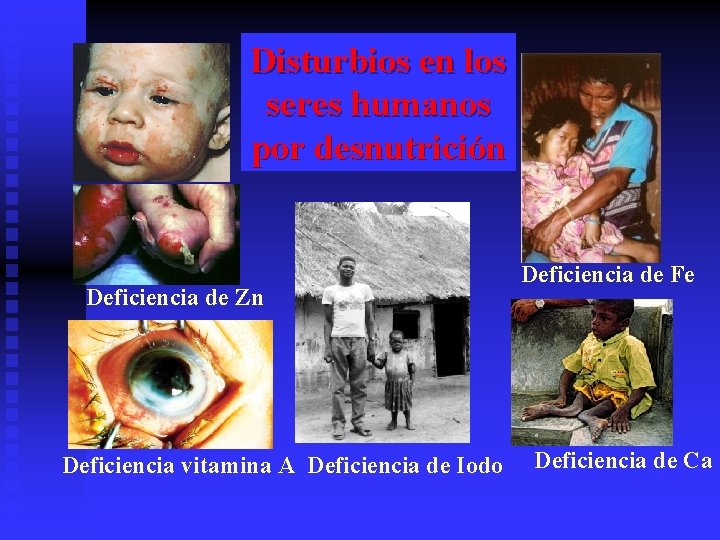 Disturbios en los seres humanos por desnutrición Deficiencia de Zn Deficiencia vitamina A Deficiencia