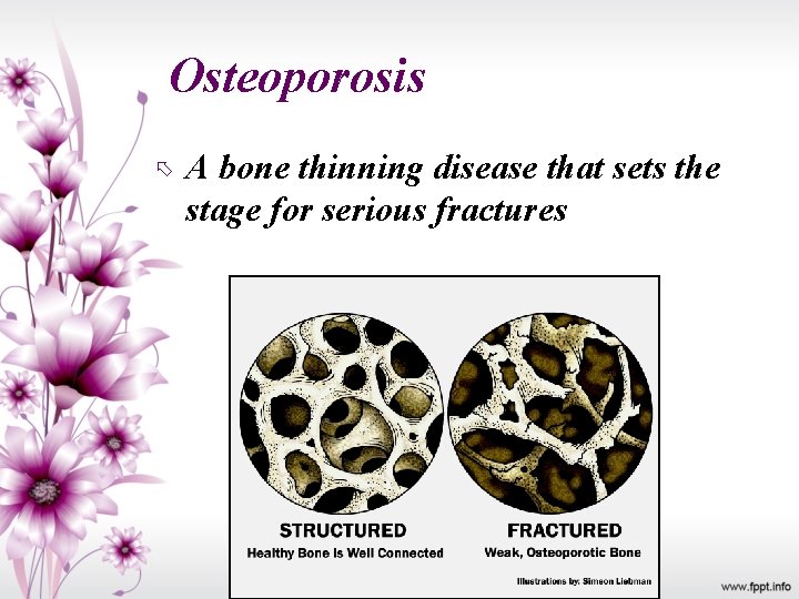 Osteoporosis A bone thinning disease that sets the stage for serious fractures 