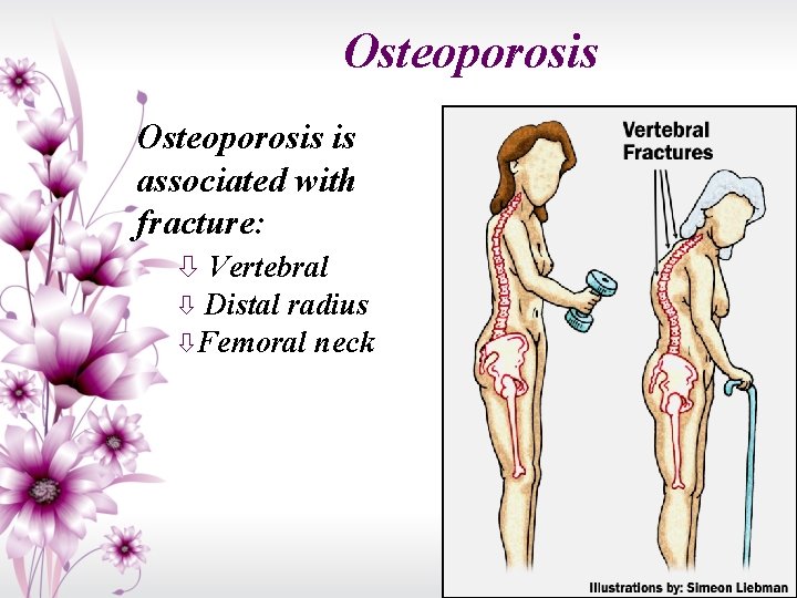 Osteoporosis is associated with fracture: Vertebral Distal radius Femoral neck 