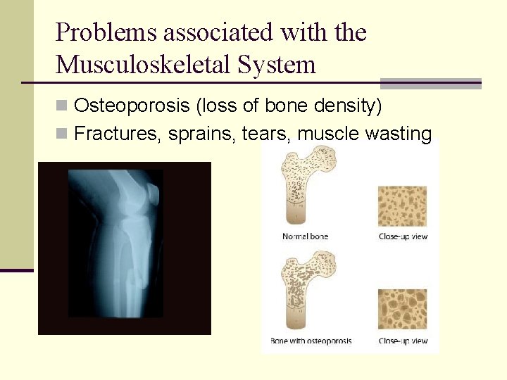 Problems associated with the Musculoskeletal System n Osteoporosis (loss of bone density) n Fractures,