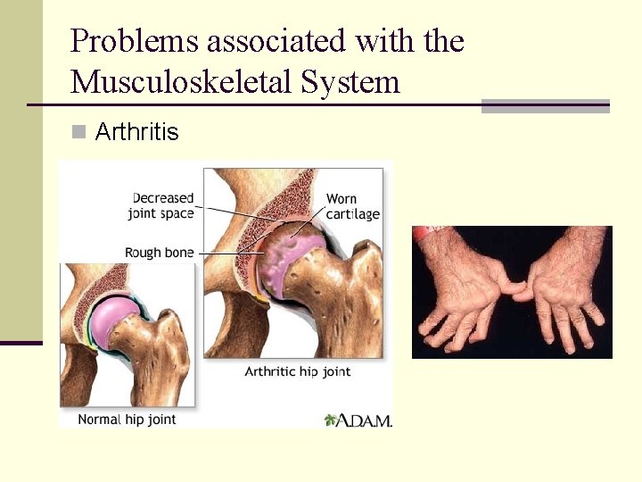 Problems associated with the Musculoskeletal System n Arthritis 