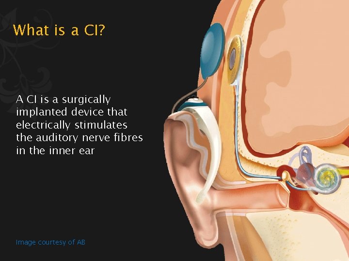 What is a CI? A CI is a surgically implanted device that electrically stimulates