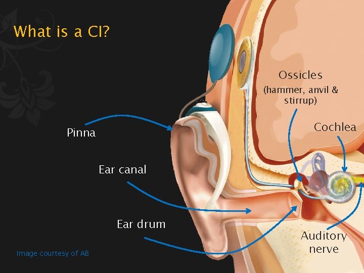 What is a CI? Ossicles (hammer, anvil & stirrup) Cochlea Pinna Ear canal Ear