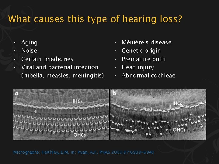What causes this type of hearing loss? • • Aging Noise Certain medicines Viral