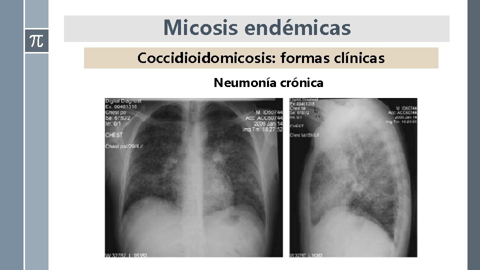 Micosis endémicas Coccidioidomicosis: formas clínicas Neumonía crónica 