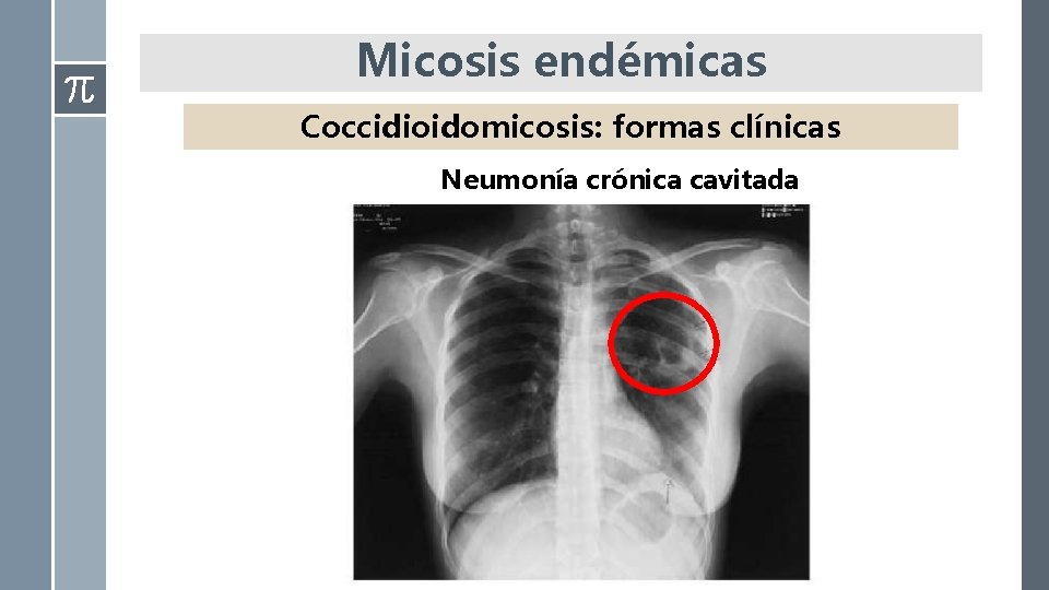 Micosis endémicas Coccidioidomicosis: formas clínicas Neumonía crónica cavitada 