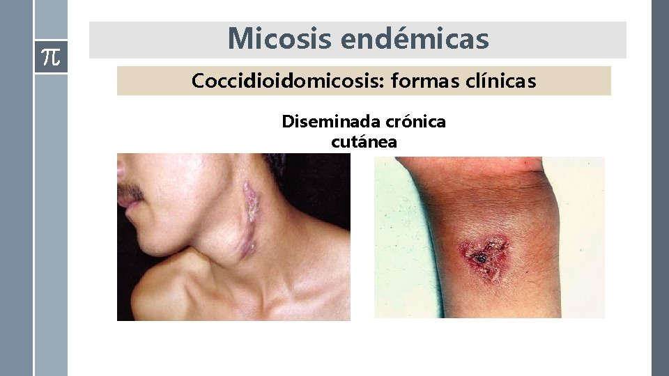 Micosis endémicas Coccidioidomicosis: formas clínicas Diseminada crónica cutánea 