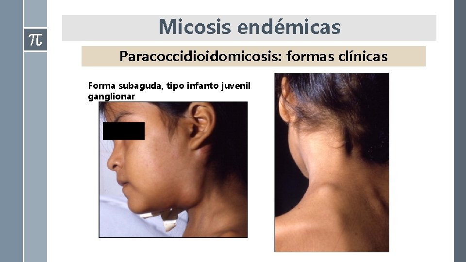 Micosis endémicas Paracoccidioidomicosis: formas clínicas Forma subaguda, tipo infanto juvenil ganglionar 