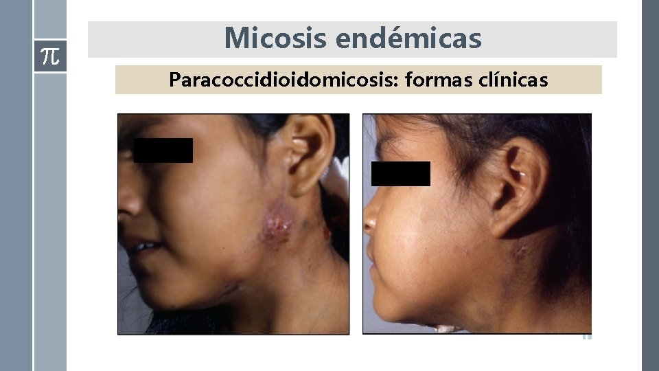 Micosis endémicas Paracoccidioidomicosis: formas clínicas 