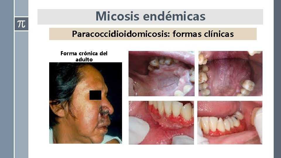 Micosis endémicas Paracoccidioidomicosis: formas clínicas Forma crónica del adulto 