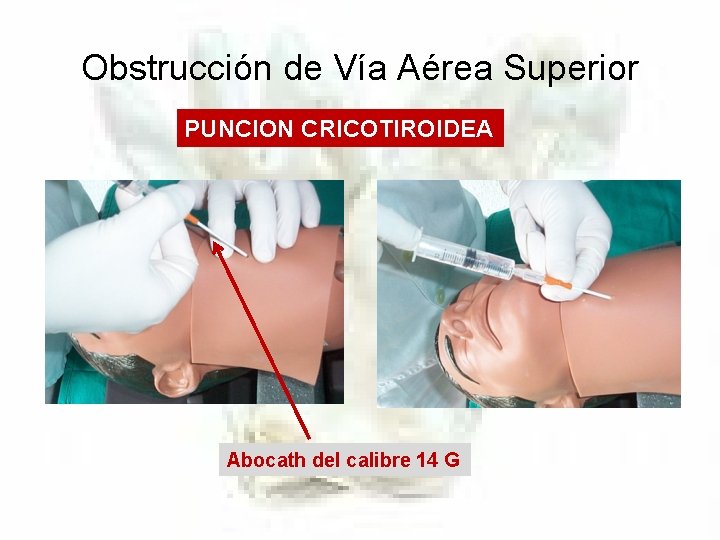 Obstrucción de Vía Aérea Superior PUNCION CRICOTIROIDEA Abocath del calibre 14 G 