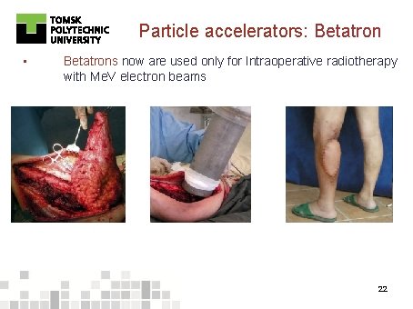 Particle accelerators: Betatron • Betatrons now are used only for Intraoperative radiotherapy with Me.