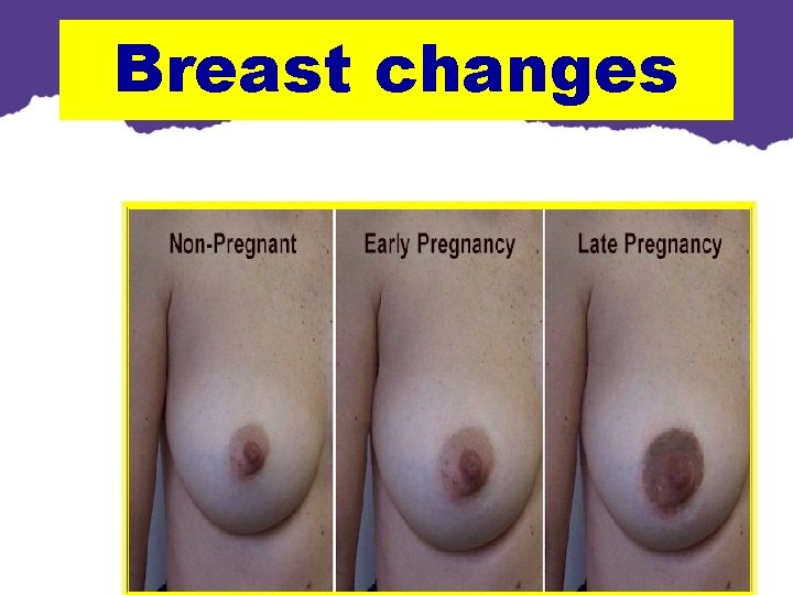 Breast changes Breast changes