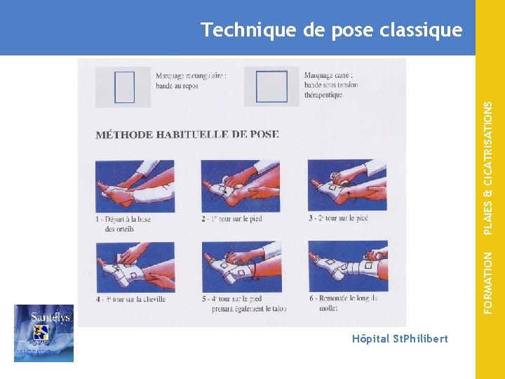 FORMATION PLAIES & CICATRISATIONS Technique de pose classique Hôpital St. Philibert 