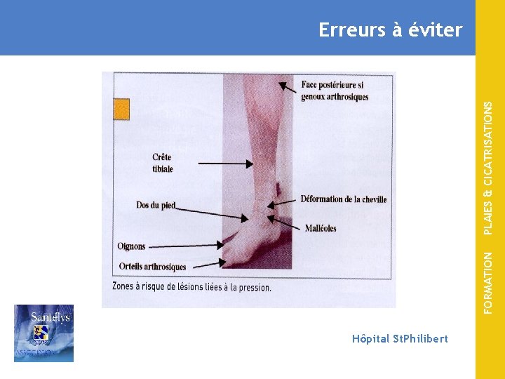 FORMATION PLAIES & CICATRISATIONS Erreurs à éviter Hôpital St. Philibert 