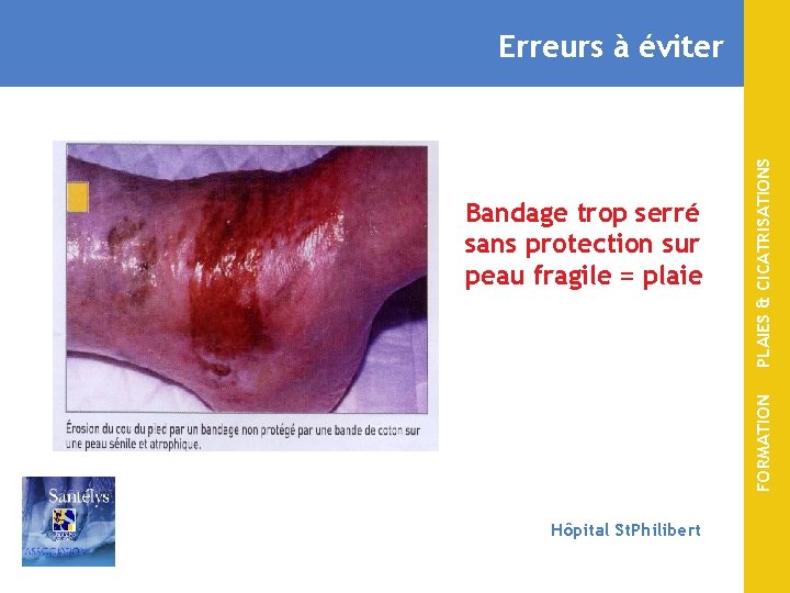 FORMATION Bandage trop serré sans protection sur peau fragile = plaie PLAIES & CICATRISATIONS