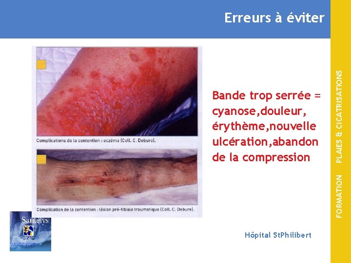 FORMATION Bande trop serrée = cyanose, douleur, érythème, nouvelle ulcération, abandon de la compression