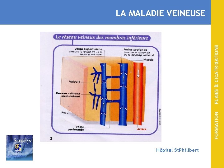 FORMATION PLAIES & CICATRISATIONS LA MALADIE VEINEUSE Hôpital St. Philibert 