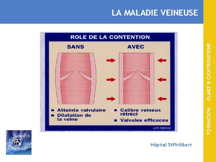 FORMATION PLAIES & CICATRISATIONS LA MALADIE VEINEUSE Hôpital St. Philibert 