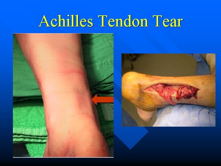 Achilles Tendon Tear n 