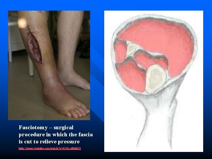 Fasciotomy – surgical procedure in which the fascia is cut to relieve pressure http: