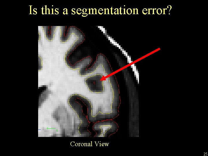 Is this a segmentation error? Coronal View 25 
