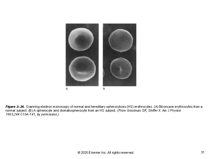 Figure 3– 30. Scanning electron microscopy of normal and hereditary spherocytosis (HS) erythrocytes. (A) Figure 3– 30. Scanning electron microscopy of normal and hereditary spherocytosis (HS) erythrocytes. (A)