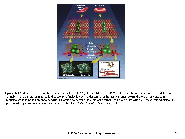 Figure 3– 31. Molecular basis of the irreversible sickle cell (ISC). The inability of Figure 3– 31. Molecular basis of the irreversible sickle cell (ISC). The inability of