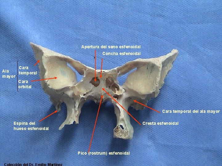 Apertura del seno esfenoidal Concha esfenoidal Cara Ala temporal mayor Cara orbital Cara temporal