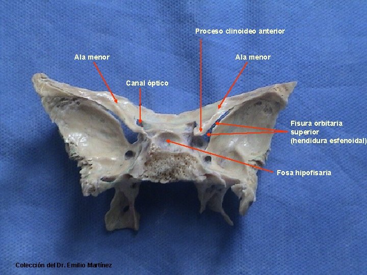 Proceso clinoideo anterior Ala menor Canal óptico Fisura orbitaria superior (hendidura esfenoidal) Fosa hipofisaria