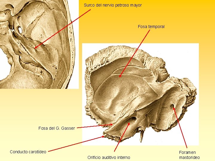 Surco del nervio petroso mayor Fosa temporal Fosa del G. Gasser Conducto carotídeo Orificio