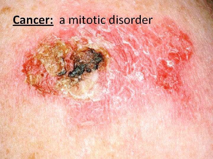 Cancer: a mitotic disorder 
