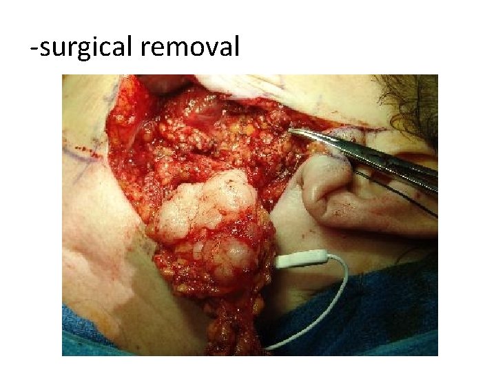 -surgical removal 