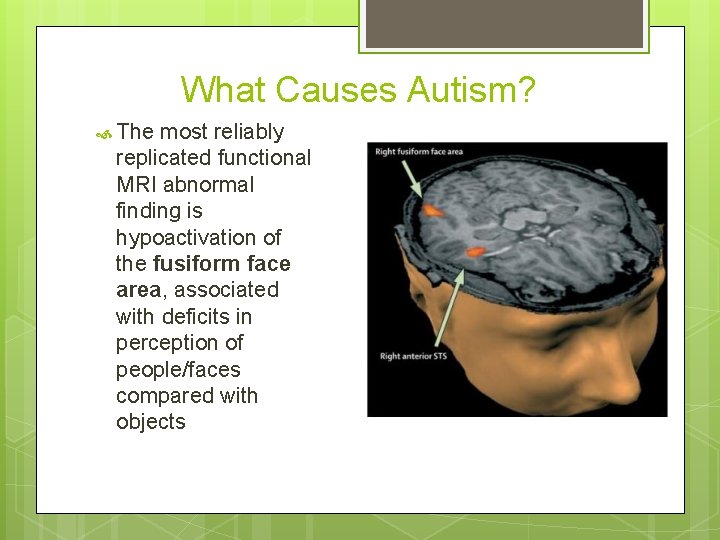 What Causes Autism? The most reliably replicated functional MRI abnormal finding is hypoactivation of
