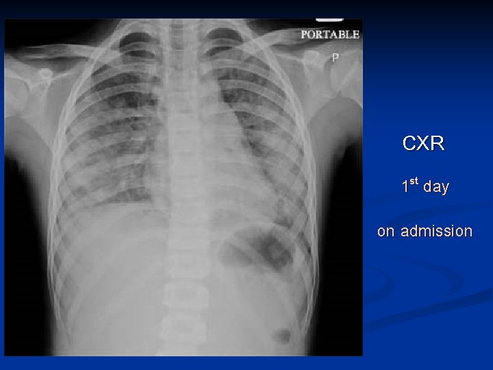 CXR 1 st day on admission 