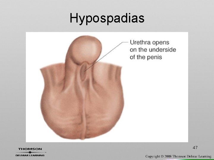 Hypospadias 47 