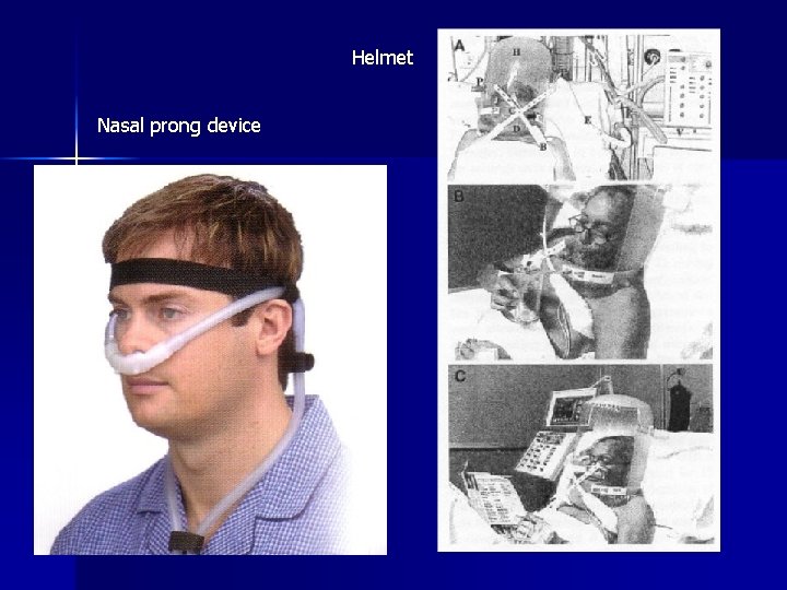 Helmet Nasal prong device 