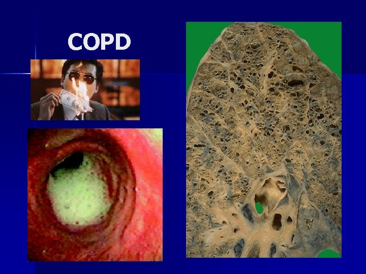 COPD 