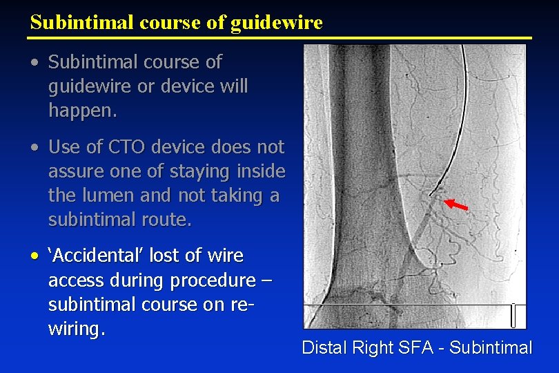 Subintimal course of guidewire • Subintimal course of guidewire or device will happen. •