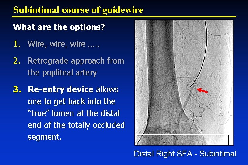 Subintimal course of guidewire What are the options? 1. Wire, wire …. . 2.