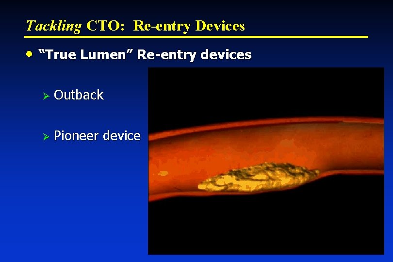 Tackling CTO: Re-entry Devices • “True Lumen” Re-entry devices Ø Outback Ø Pioneer device