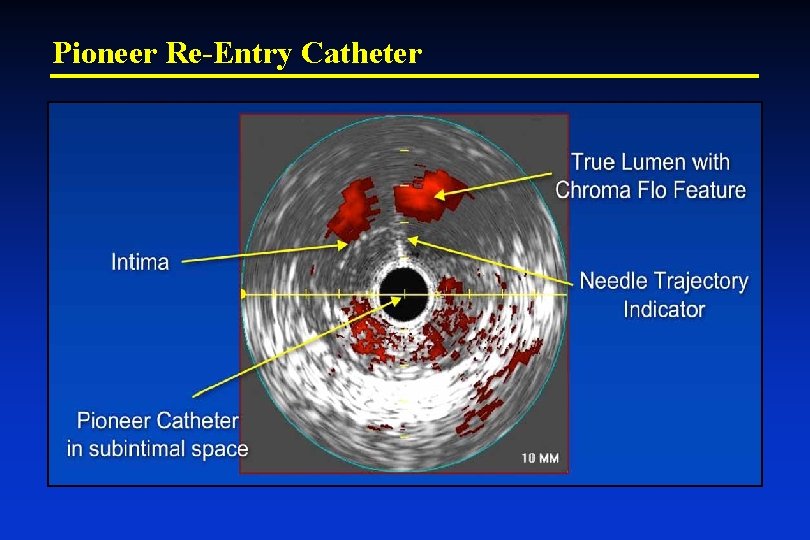 Pioneer Re-Entry Catheter 