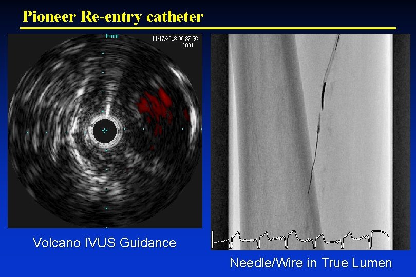 Pioneer Re-entry catheter Volcano IVUS Guidance Needle/Wire in True Lumen 