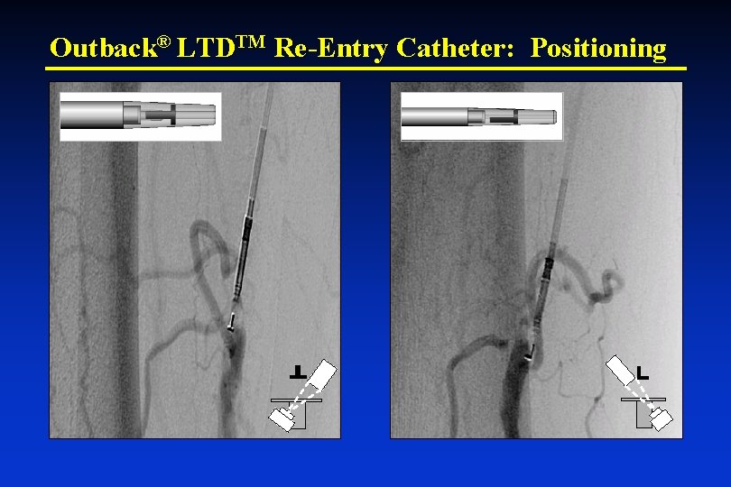 Outback® LTDTM Re-Entry Catheter: Positioning 