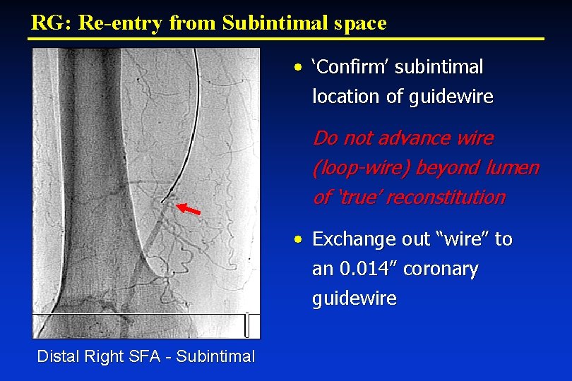 RG: Re-entry from Subintimal space • ‘Confirm’ subintimal location of guidewire Do not advance