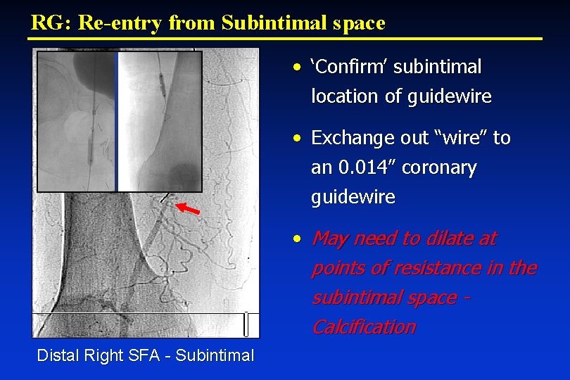 RG: Re-entry from Subintimal space • ‘Confirm’ subintimal location of guidewire • Exchange out